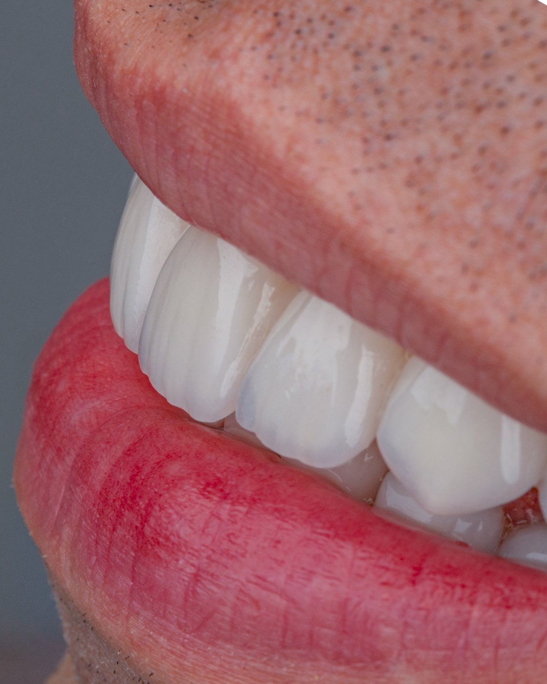 Detalle de perfil donde se aprecia la traslucidez y el mimetismo natural del disilicato de litio estratificado a mano por la Dra. Lina Bedoya.