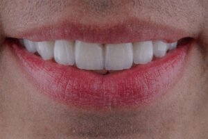 Arquitectura dental masculina mediante carillas de disilicato de litio estratificadas, resaltando la integración oclusal y estética natural realizada por la Dra. Lina Bedoya.