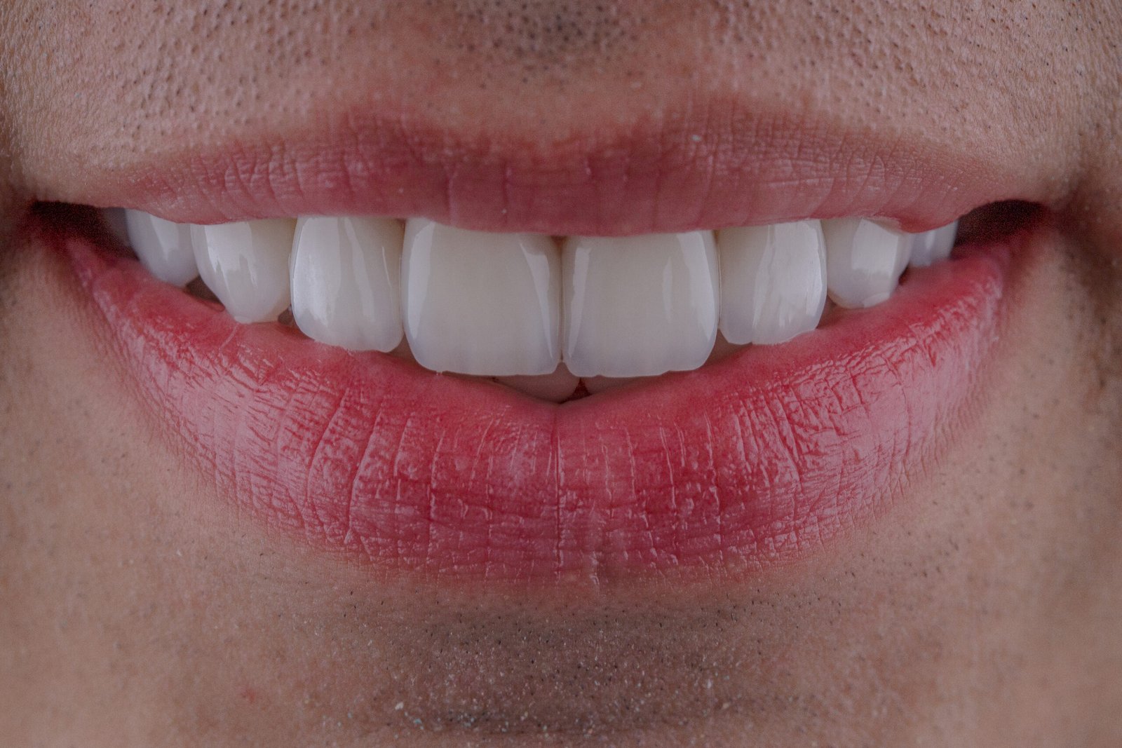 Arquitectura dental masculina mediante carillas de disilicato de litio estratificadas, resaltando la integración oclusal y estética natural realizada por la Dra. Lina Bedoya.