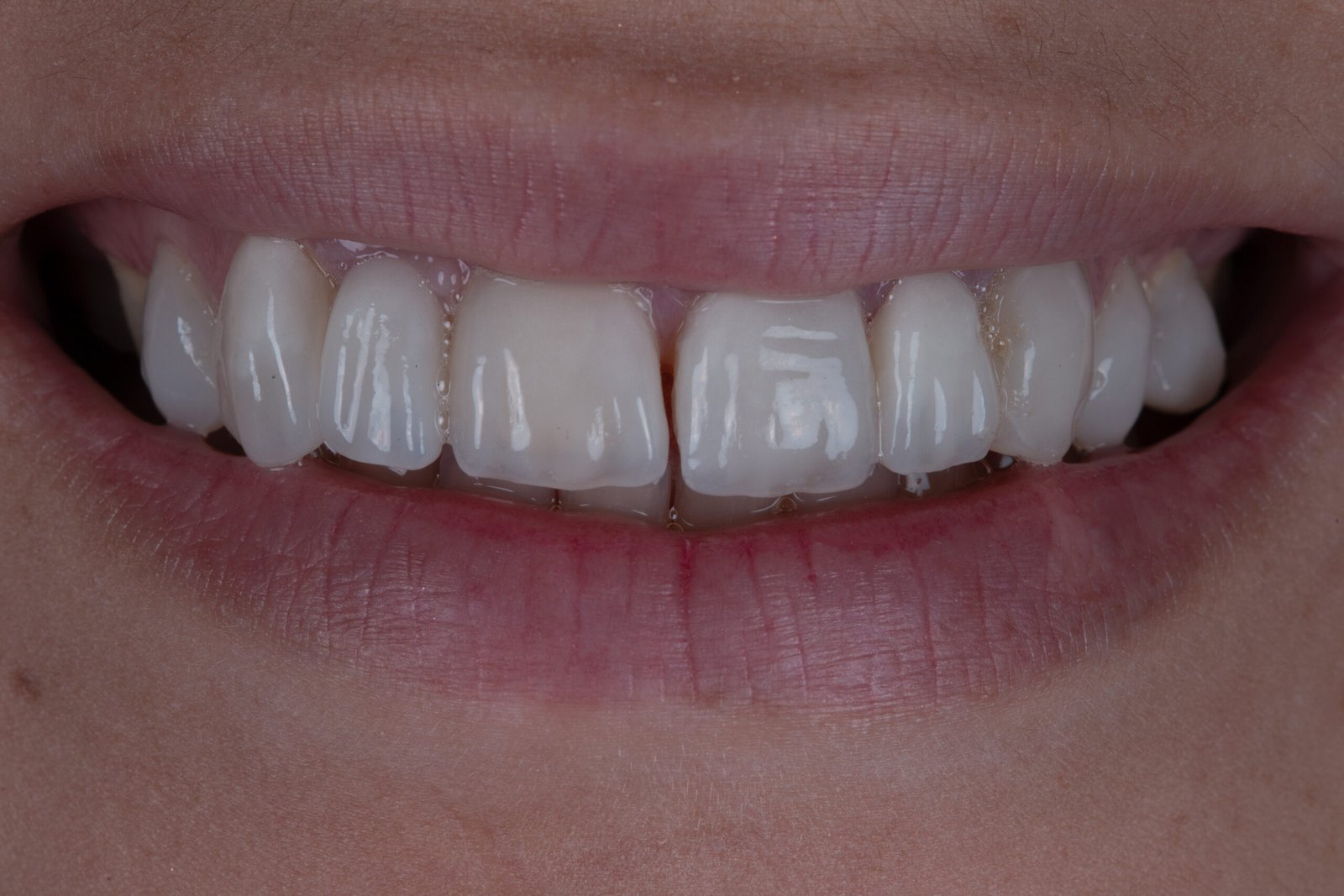 Evaluación facial inicial de la paciente mostrando anodoncia y el estado de las prótesis anteriores mal adaptadas antes de su rehabilitación estética por la Dra. Lina Bedoya.