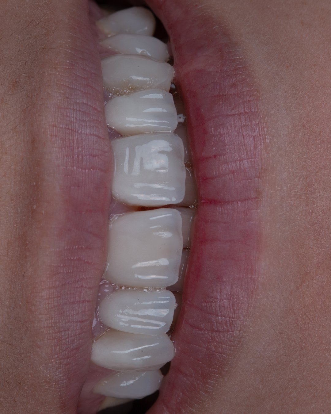 Vista clínica inicial de paciente con anodoncia y prótesis antiguas mal adaptadas, evidenciando falta de armonía y salud gingival.