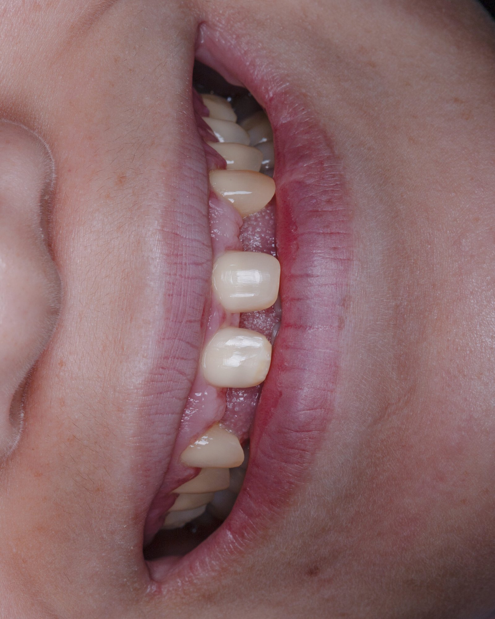 Fotografía clínica inicial de paciente con anodoncia parcial, mostrando la distribución de espacios y la necesidad de rehabilitación estética y funcional por la Dra. Lina Bedoya.