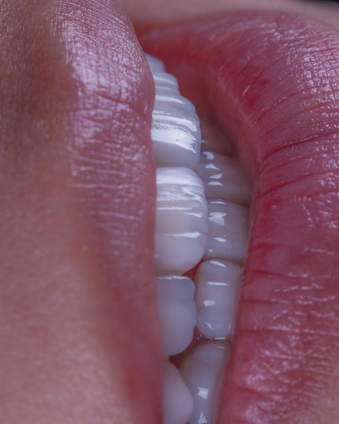 Resultado de alta estética en caso de anodoncia con carillas e.max de Ivoclar, mostrando la perfecta integración de la cerámica estratificada por la Dra. Lina Bedoya.