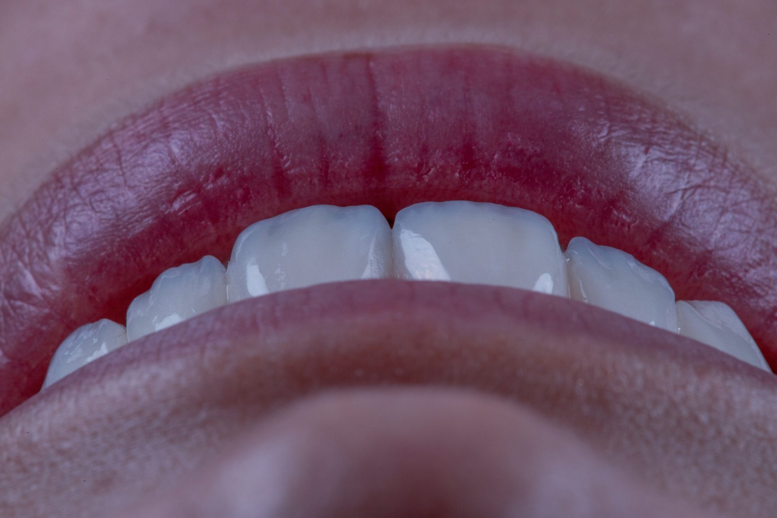 Macrofotografía de los bordes incisales de carillas e.max de Ivoclar, mostrando la estratificación manual y opalescencia natural diseñada por la Dra. Lina Bedoya.