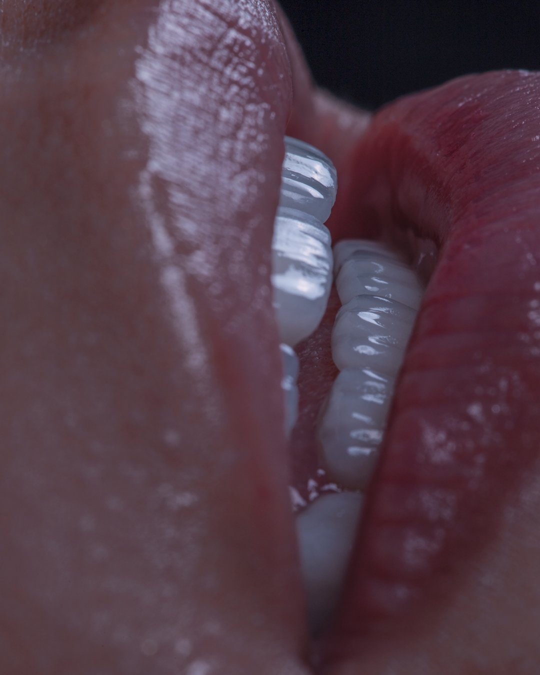 Detalle artístico de perfil donde se aprecia la textura y naturalidad de las carillas e.max de Ivoclar, estratificadas a mano para corregir anodoncia por la Dra. Lina Bedoya.