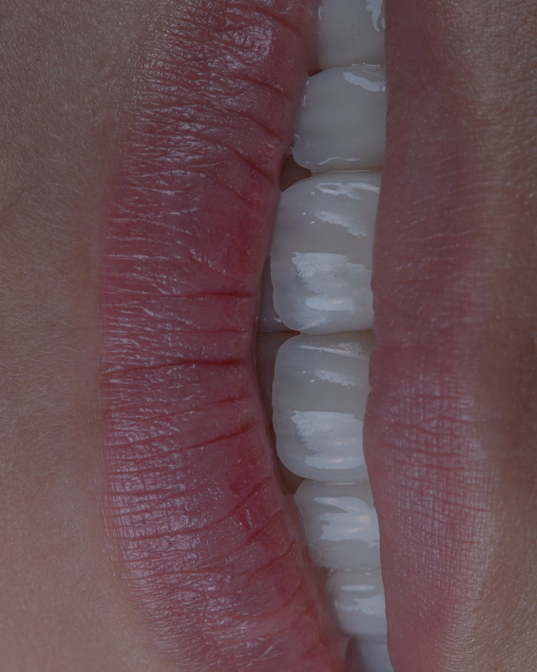 Macrofotografía de carillas en disilicato de litio e.max de Ivoclar, con estratificación manual detallada para recrear la anatomía y el brillo natural del esmalte, por la Dra. Lina Bedoya.