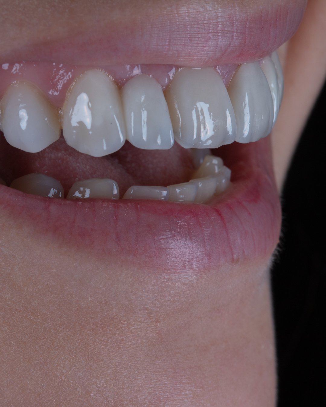 Documentación clínica de sonrisa con desbalance estético debido a la anodoncia y restauraciones previas en mal estado, previa a la intervención de la Dra. Lina Bedoya.