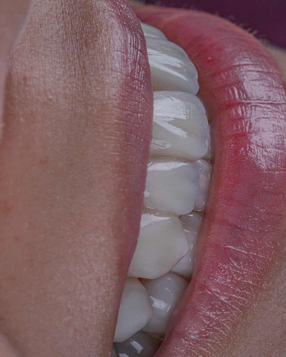 Detalle de la reflexión de luz y naturalidad en carillas de disilicato de litio e.max de ivoclar, técnica de estratificación manual realizada por la dra. lina bedoya.