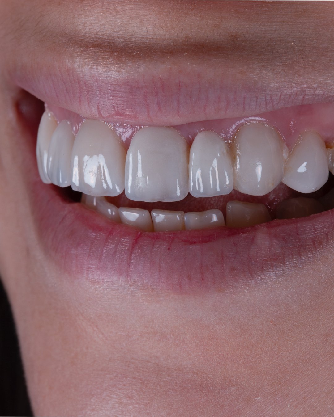 Captura lateral del estado previo a la rehabilitación, donde se observa la desadaptación de las carillas anteriores y el efecto de la anodoncia en el perfil de la paciente de la Dra. Lina Bedoya.