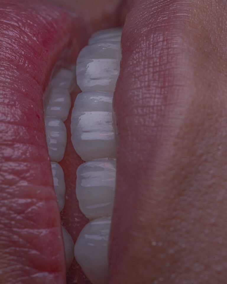 Sonrisa final rehabilitada con carillas de disilicato de litio e.max de Ivoclar, estratificadas a mano para lograr máxima naturalidad y mimetismo dental por la Dra. Lina Bedoya.