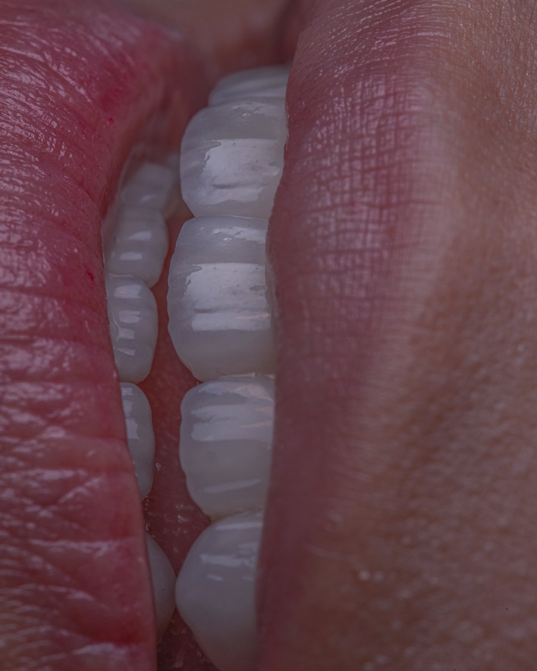 Sonrisa final rehabilitada con carillas de disilicato de litio e.max de Ivoclar, estratificadas a mano para lograr máxima naturalidad y mimetismo dental por la Dra. Lina Bedoya.