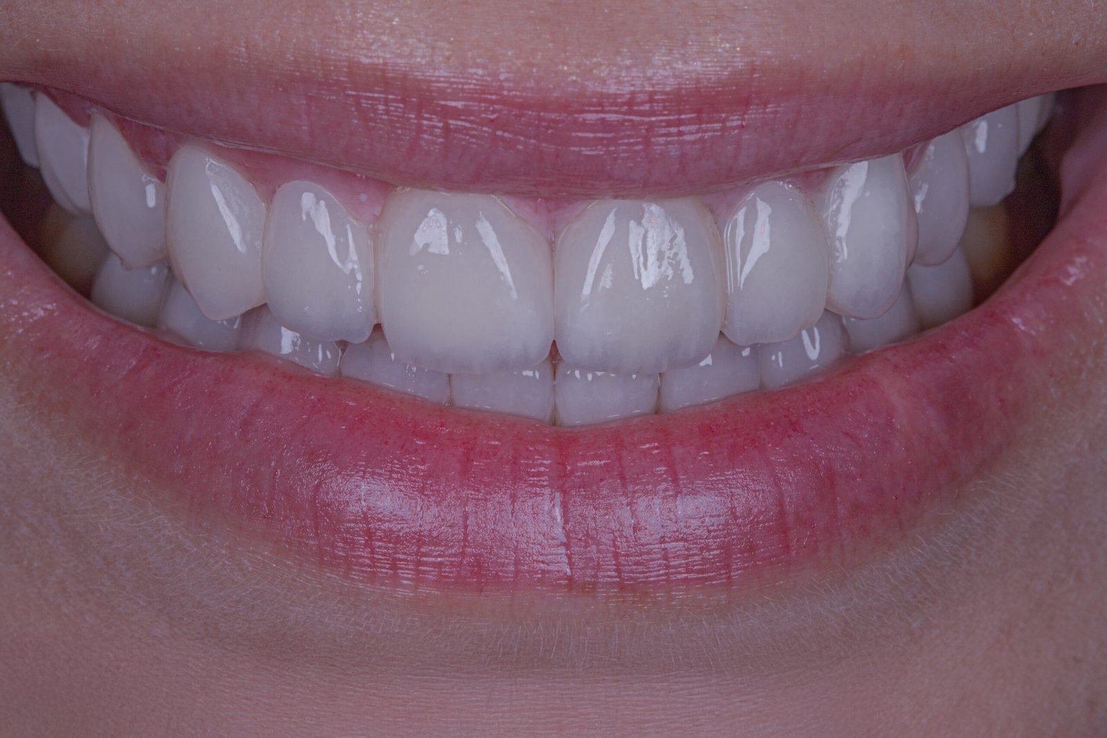 Resultado final frontal de la rehabilitación oral con carillas de disilicato de litio e.max de Ivoclar, estratificadas a mano para un acabado natural por la Dra. Lina Bedoya.