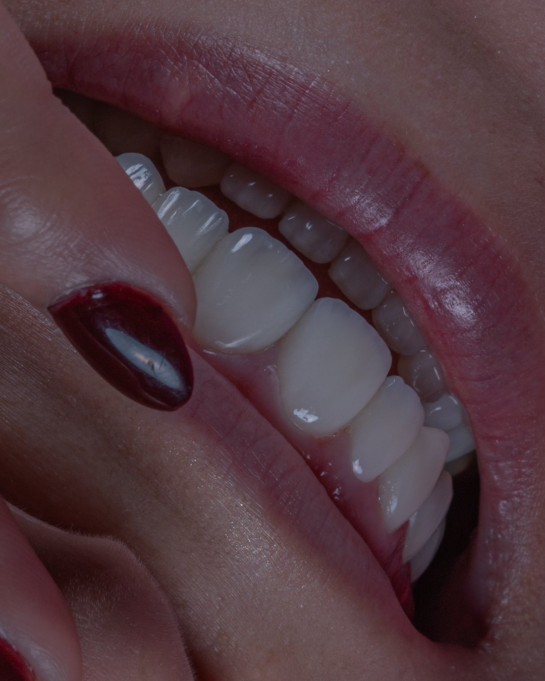 Primer plano de la paciente interactuando con su nueva sonrisa, resaltando la naturalidad de las carillas e.max de Ivoclar estratificadas a mano por la Dra. Lina Bedoya