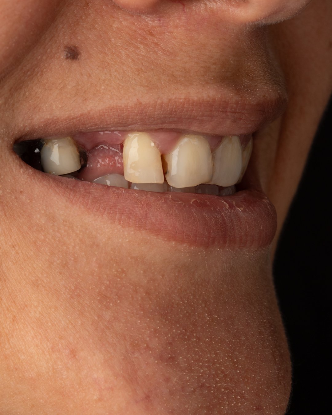 Vista lateral inicial del caso 06 evidenciando ausencia de piezas dentales en el sector posterior y desarmonía en el plano oclusal antes de la intervención de la dra. lina bedoya.