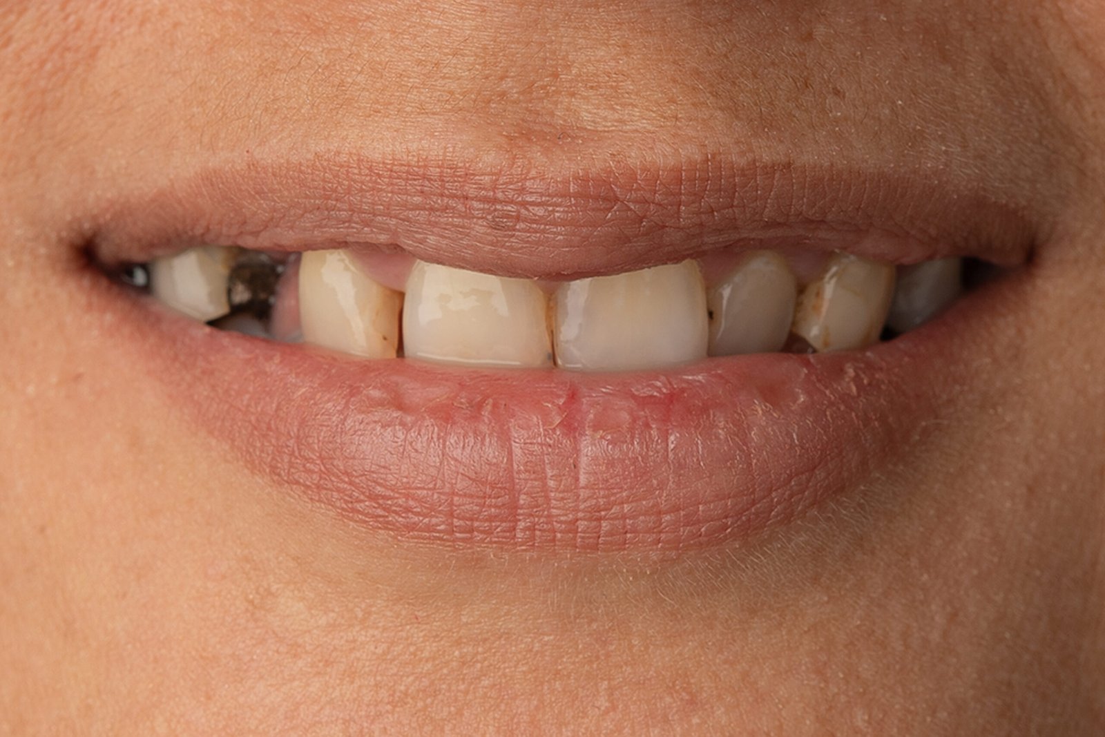 Vista inicial de los dientes naturales de la paciente evidenciando desgaste en bordes incisales y pérdida de la anatomía juvenil antes del tratamiento de la dra. lina bedoya.