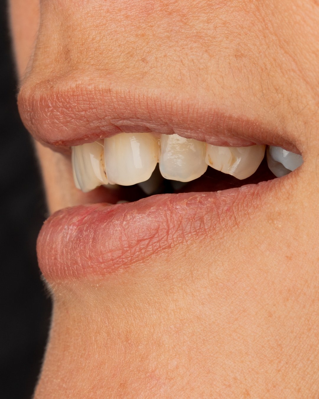 Vista lateral del estado inicial de la paciente donde se aprecia el desgaste de los bordes incisales y la pérdida de anatomía dental antes del diseño de sonrisa de la dra. lina bedoya