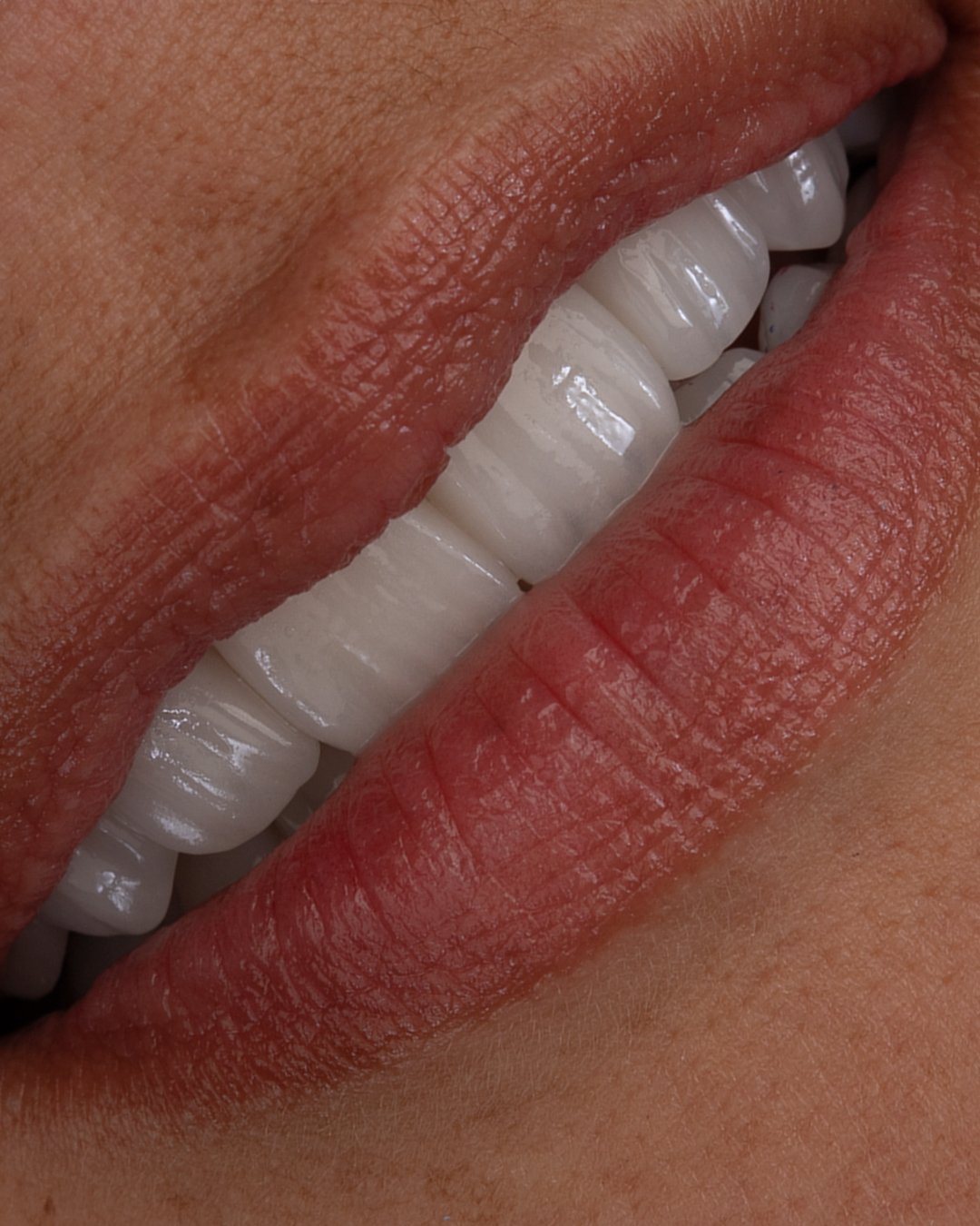 Vista en ángulo de la sonrisa final, resaltando la naturalidad, el brillo y la integración de las carillas e.max de ivoclar estratificadas a mano por la dra. lina bedoya.