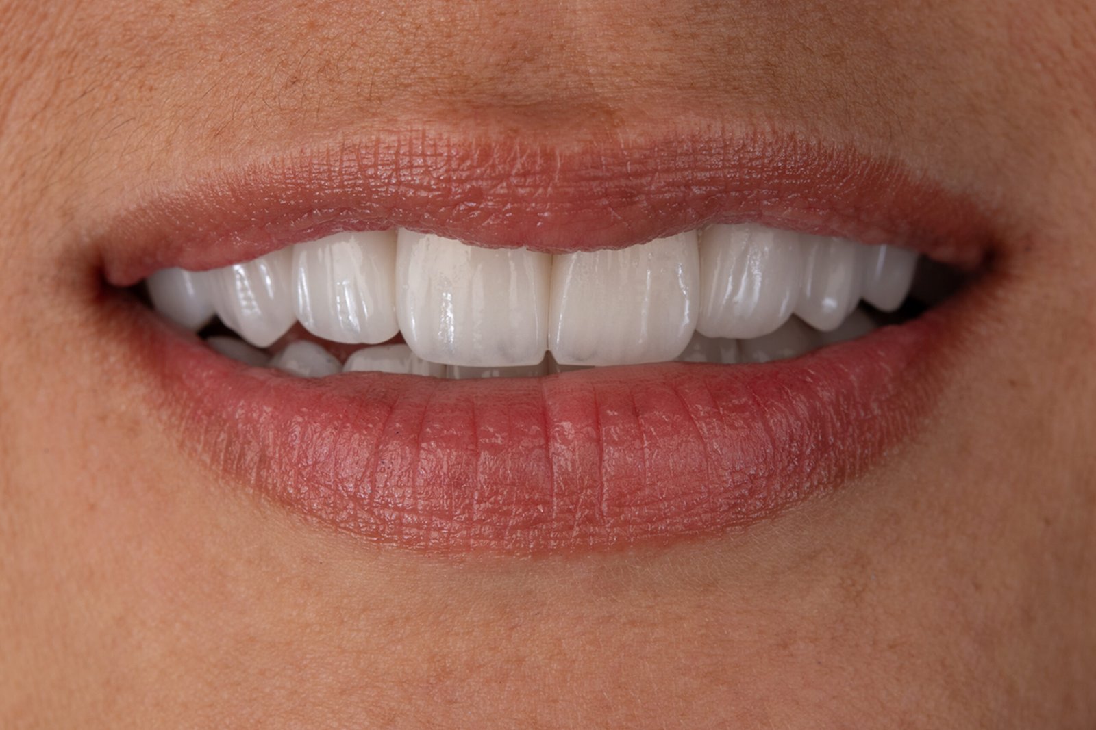 Resultado final del diseño de sonrisa con carillas en disilicato de litio e.max de ivoclar, mostrando la armonía y vitalidad recuperada por la dra. lina bedoya.