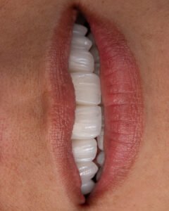Vista frontal completa de la rehabilitación con carillas en disilicato de litio e.max de ivoclar, mostrando la armonía del arco dental diseñada por la dra. lina bedoya.