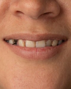 Análisis clínico inicial de la paciente evidenciando restauraciones antiguas desadaptadas, cambios de color y compromiso de la salud gingival antes del tratamiento por la dra. lina bedoya.