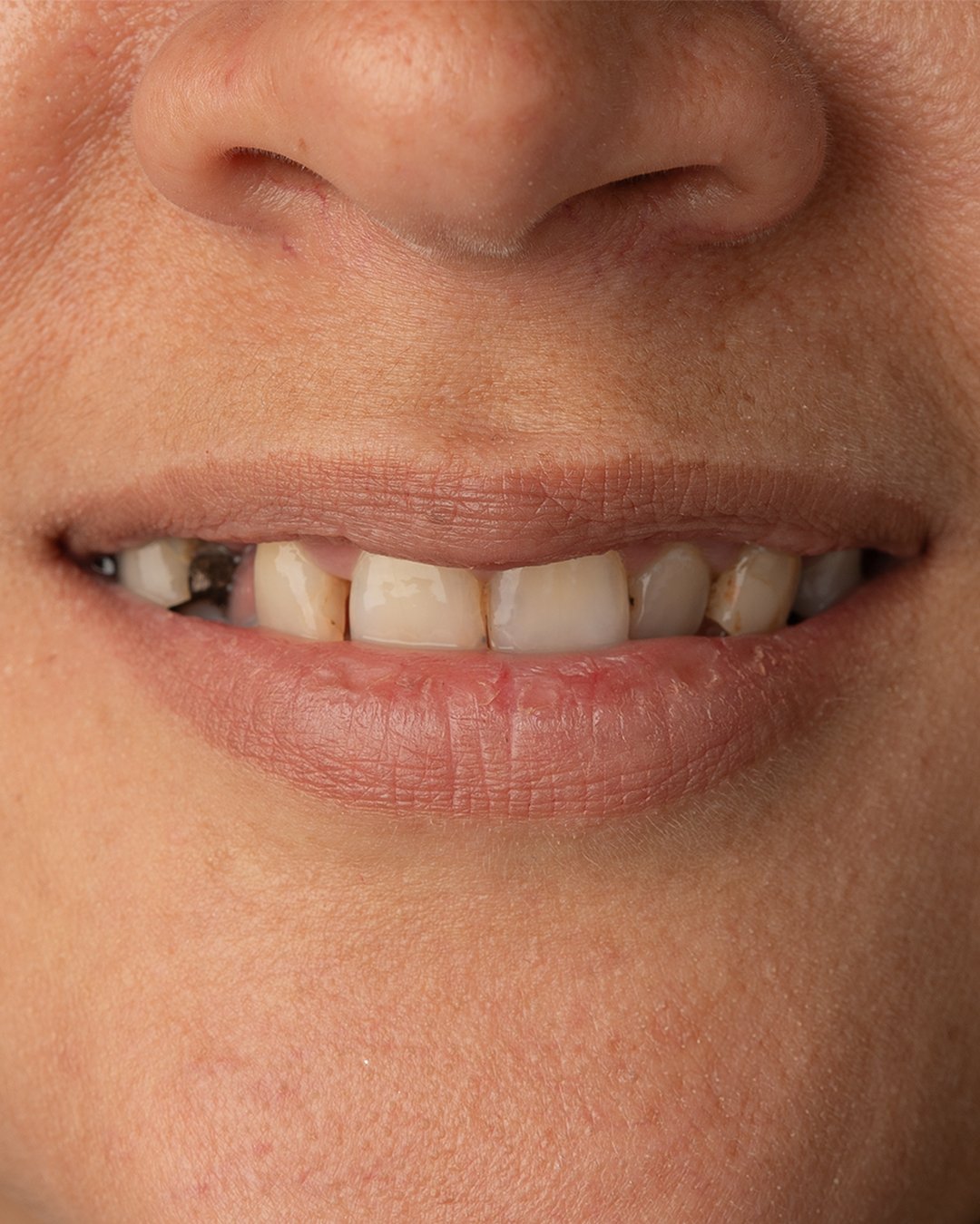 Análisis clínico inicial de la paciente evidenciando restauraciones antiguas desadaptadas, cambios de color y compromiso de la salud gingival antes del tratamiento por la dra. lina bedoya.