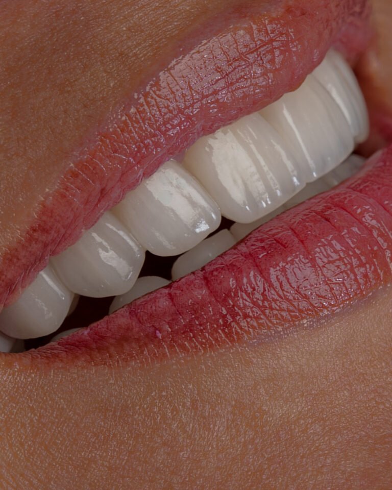Detalle lateral de carillas en disilicato de litio e.max de ivoclar, destacando la traslucidez y anatomía lograda mediante estratificación manual por la dra. lina bedoya.