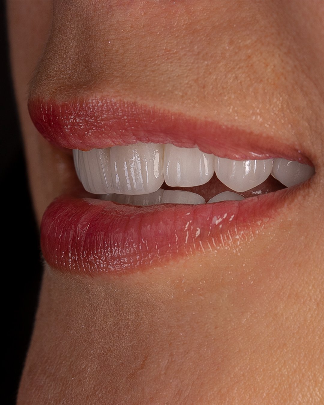 Detalle de la sonrisa terminada con carillas en disilicato de litio e.max de ivoclar, destacando la textura natural y el soporte labial logrado por la dra. lina bedoya.