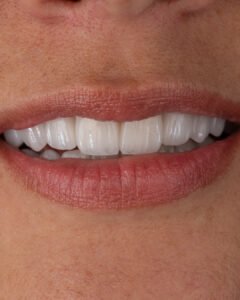 plano detallado de la sonrisa final con carillas en disilicato de litio e.max de ivoclar, destacando la mamelonización y bordes incisales naturales creados por la dra. lina bedoya.