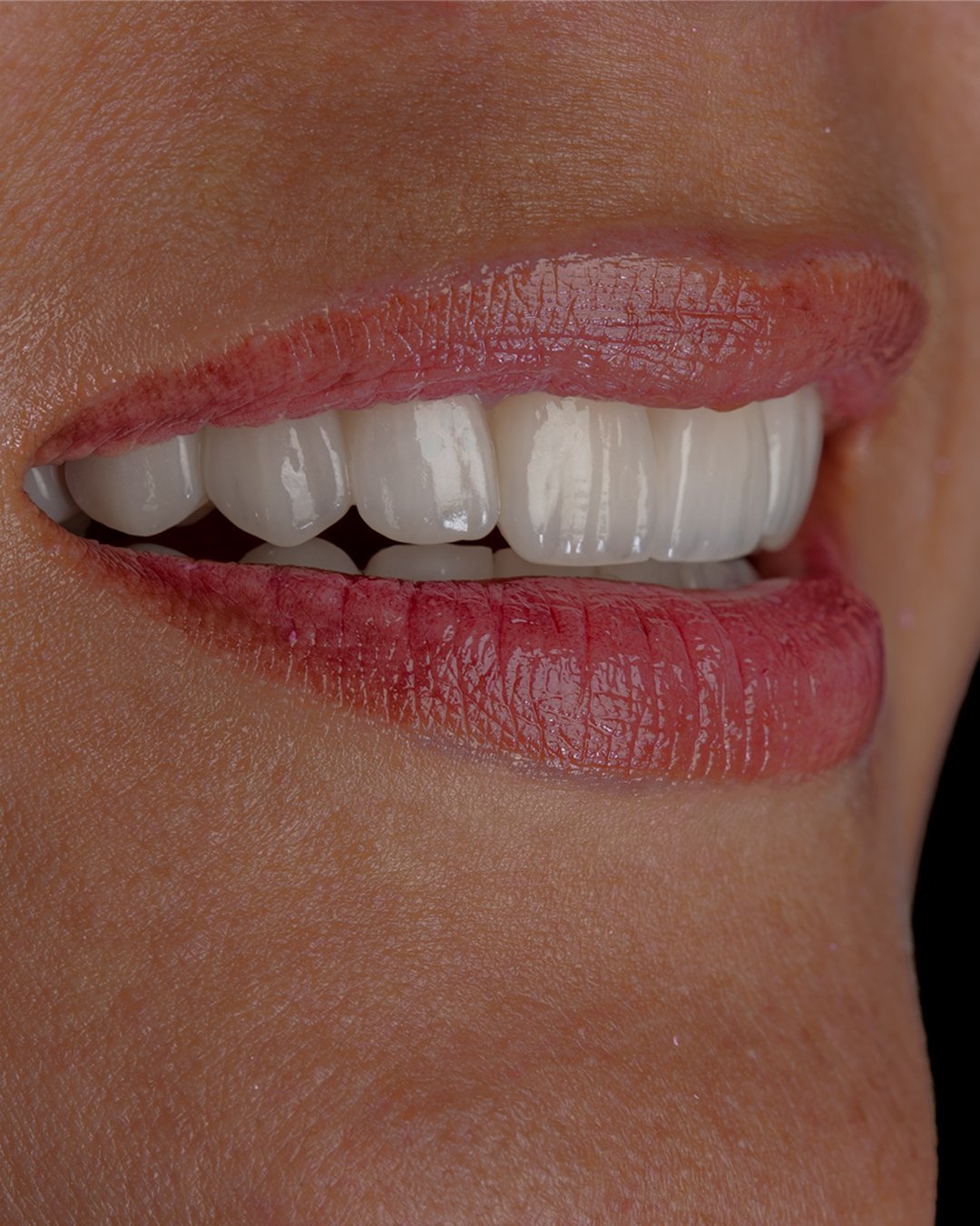 Vista de perfil que muestra la traslucidez y anatomía natural de las carillas de disilicato de litio e.max de ivoclar, diseñadas por la dra. lina bedoya.