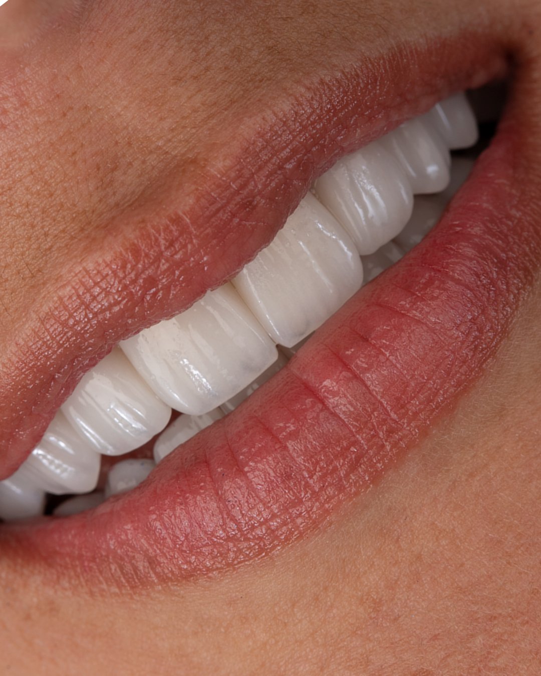 Primer plano de la paciente sonriendo, resaltando el brillo y la integración estética de las carillas de disilicato de litio e.max de ivoclar estratificadas a mano por la dra. lina bedoya.