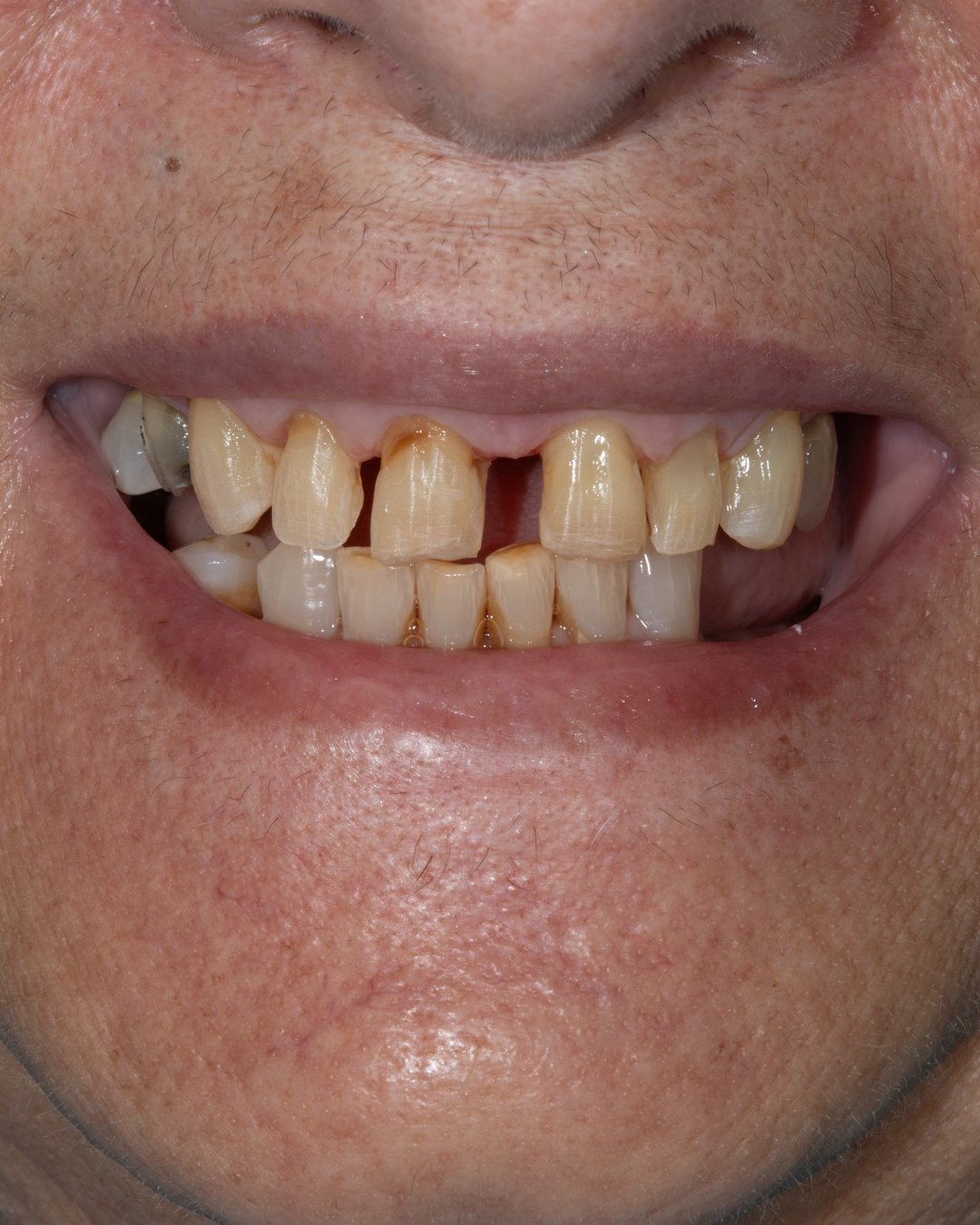 Fase intermedia del tratamiento donde se retiran las coronas en mal estado para iniciar la rehabilitación con disilicato de litio por la Dra. Lina Bedoya.