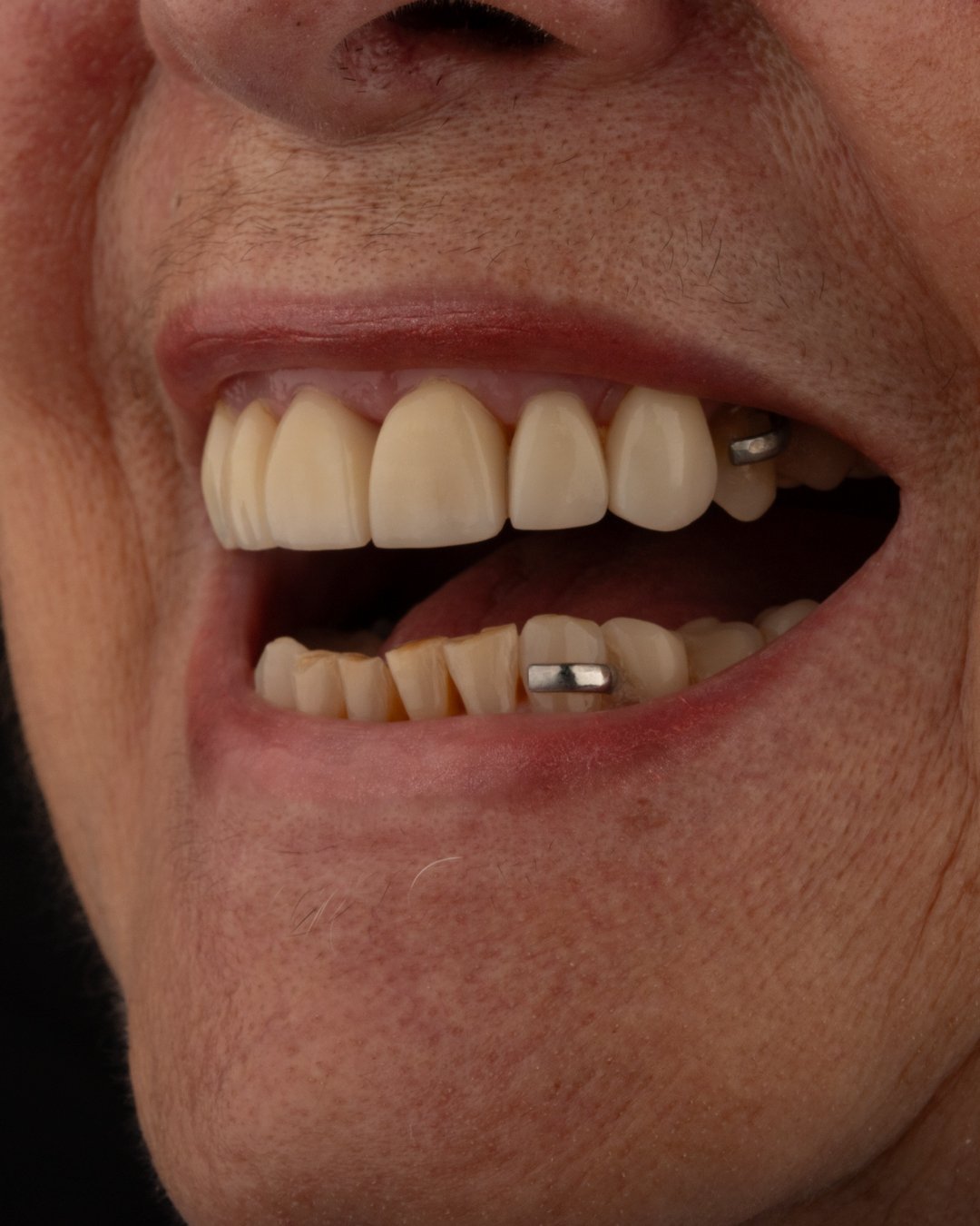 Vista clínica inicial con coronas antiguas desajustadas y presencia de espacios (diastemas) antes del tratamiento de la Dra. Lina Bedoya.