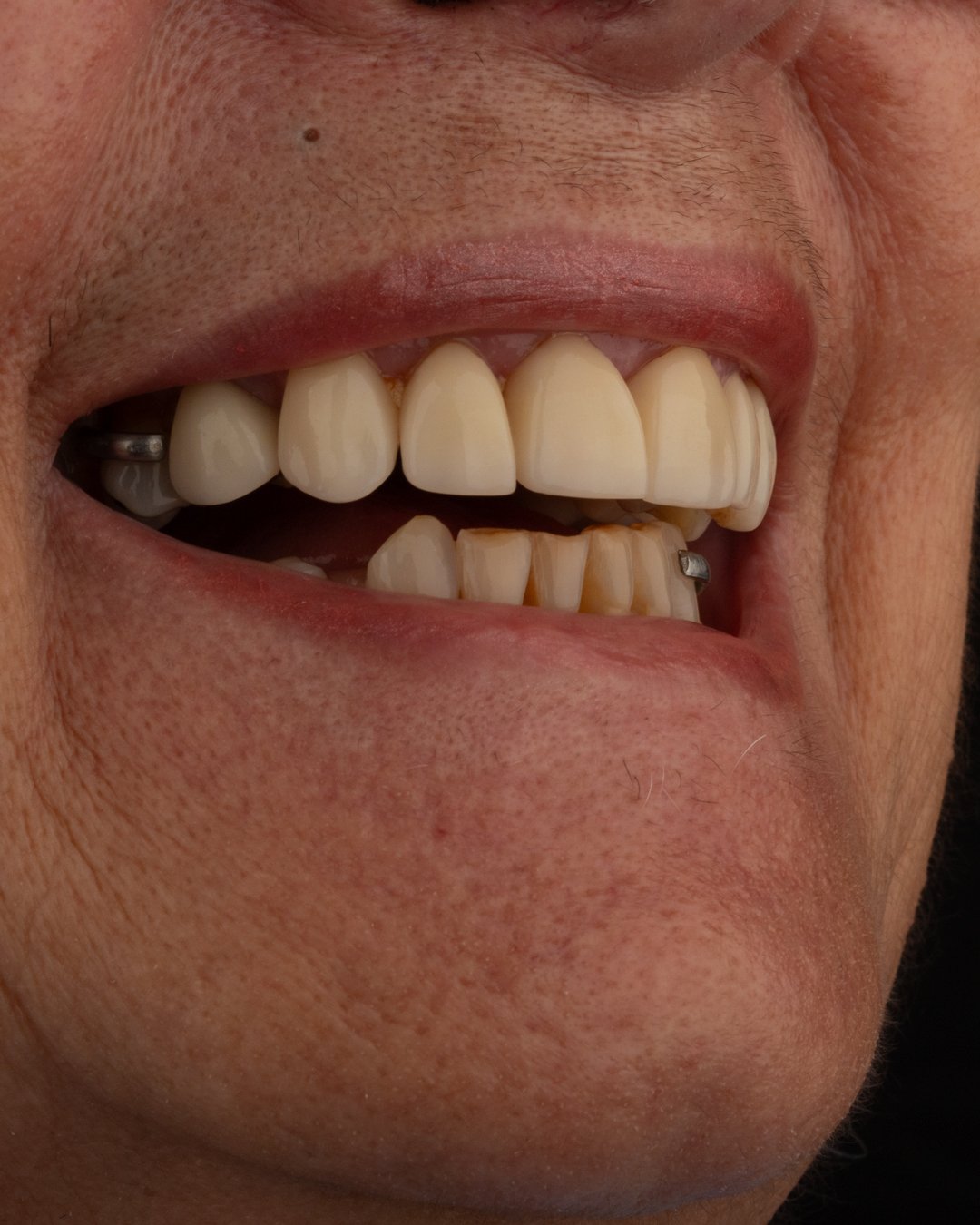 Vista lateral del estado inicial mostrando la falta de armonía en el perfil y los espacios interdentales antes del tratamiento con la Dra. Lina Bedoya.