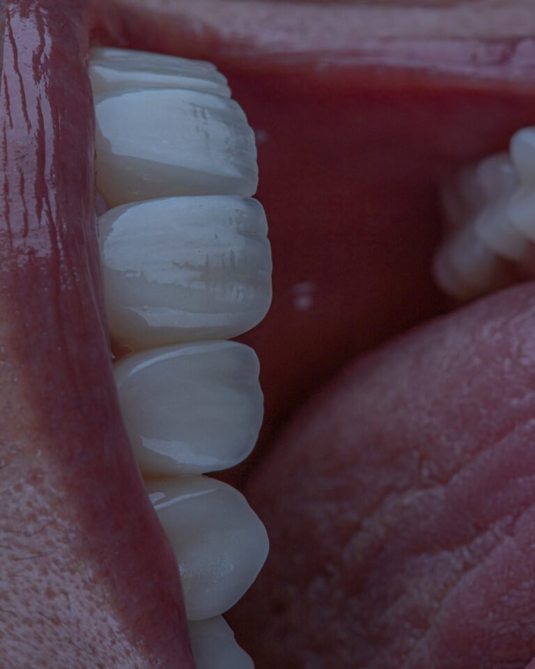 detalle de mimetismo y traslucidez en cerámica estratificada por la dra. lina bedoya