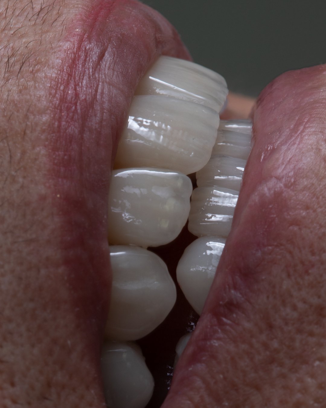 despues-detalle-textura-natural-disilicato-dra-lina-bedoya