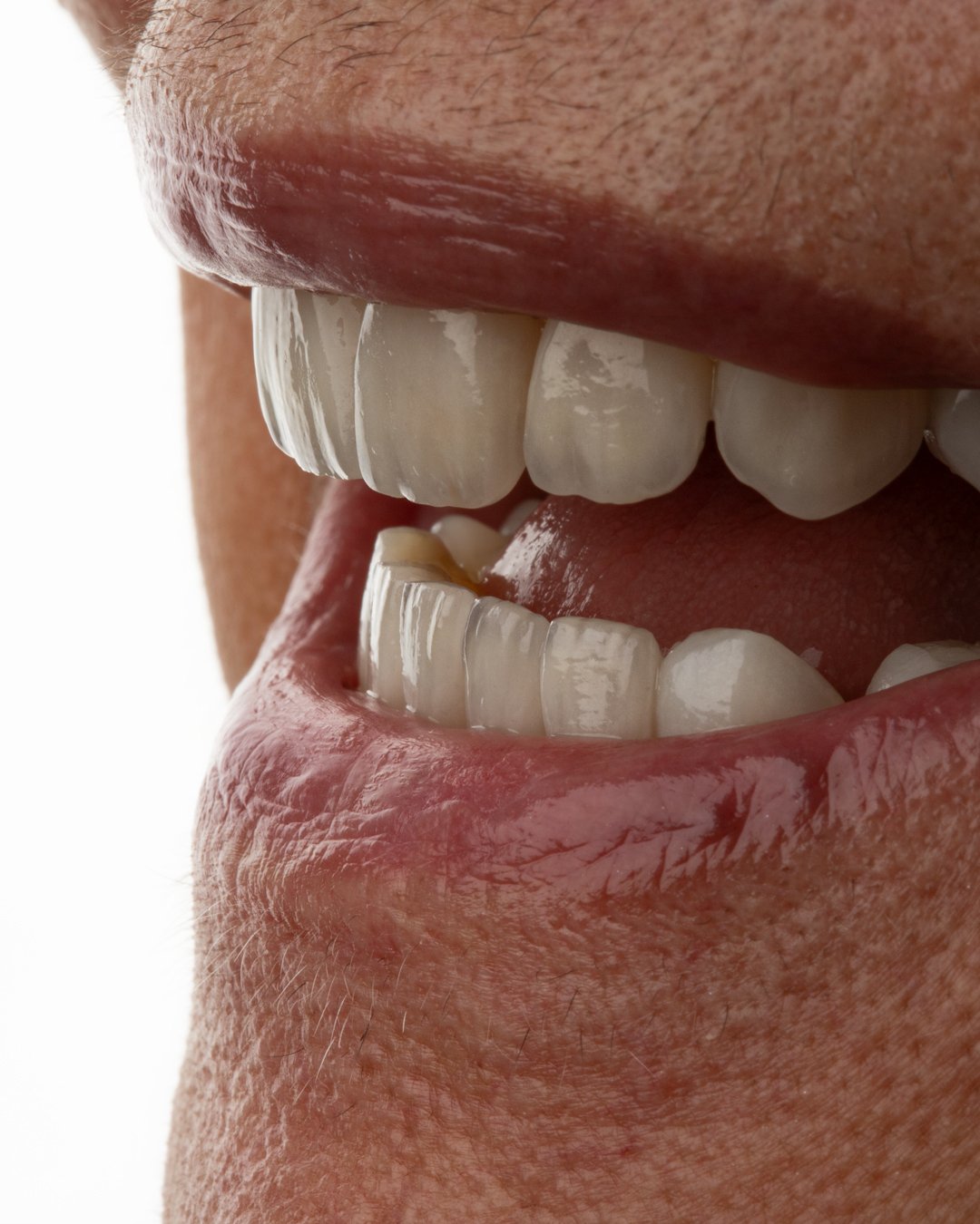 07-despues-perfil-lateral-armonia-femenina-dra-lina-bedoya