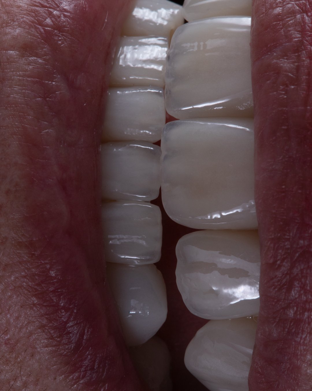 Macrofotografía lateral del resultado final destacando el brillo y la integración de las coronas de disilicato de litio de la Dra. Lina Bedoya.