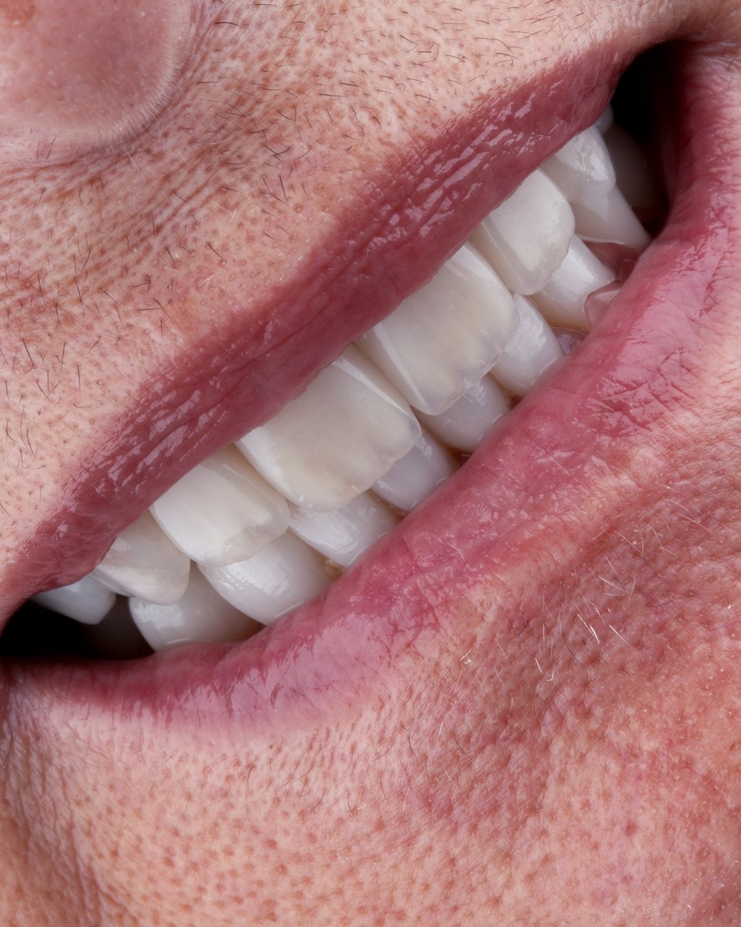 Resultado final de sonrisa natural con cierre de espacios y rehabilitación estética integral realizada por la Dra. Lina Bedoya.