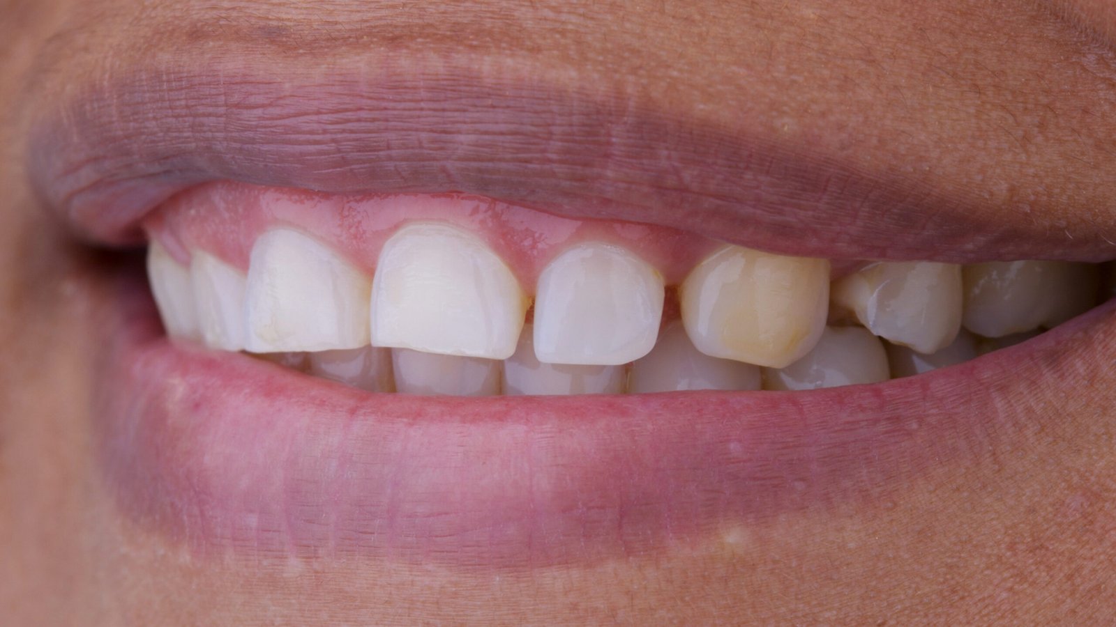 Comparativa de antes y después del diseño de sonrisa con carillas, mostrando el cambio desde una vista lateral y el cierre total de diastemas por la Dra. Lina Bedoya.