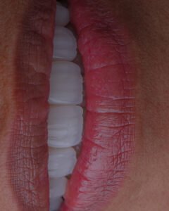 Vista frontal de carillas dentales terminadas en disilicato de litio, logrando simetría perfecta y cierre de espacios por la Dra. Lina Bedoya.
