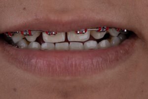 vista frontal inicial con brackets y espacios por anodoncia antes de la rehabilitación estética de la dra. lina bedoya.