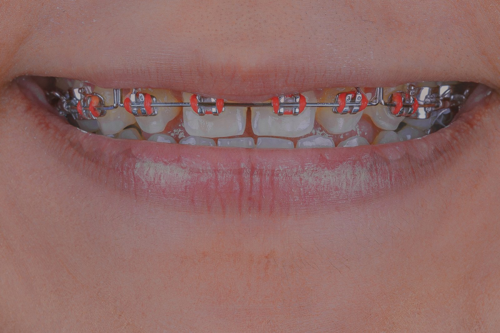 vista frontal inicial con brackets y espacios por anodoncia antes de la rehabilitación estética de la dra. lina bedoya.