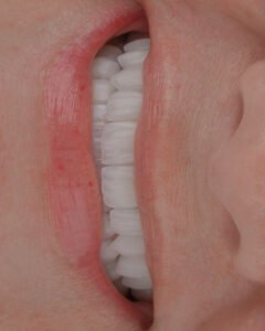Vista de arco superior finalizado con carillas de porcelana estratificadas. Integración funcional y estética de alta precisión por la Dra. Lina Bedoya.