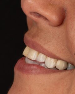 vista lateral inicial donde se observa el desgaste dental y la pérdida de dimensión vertical antes del tratamiento con la Dra. Lina Bedoya