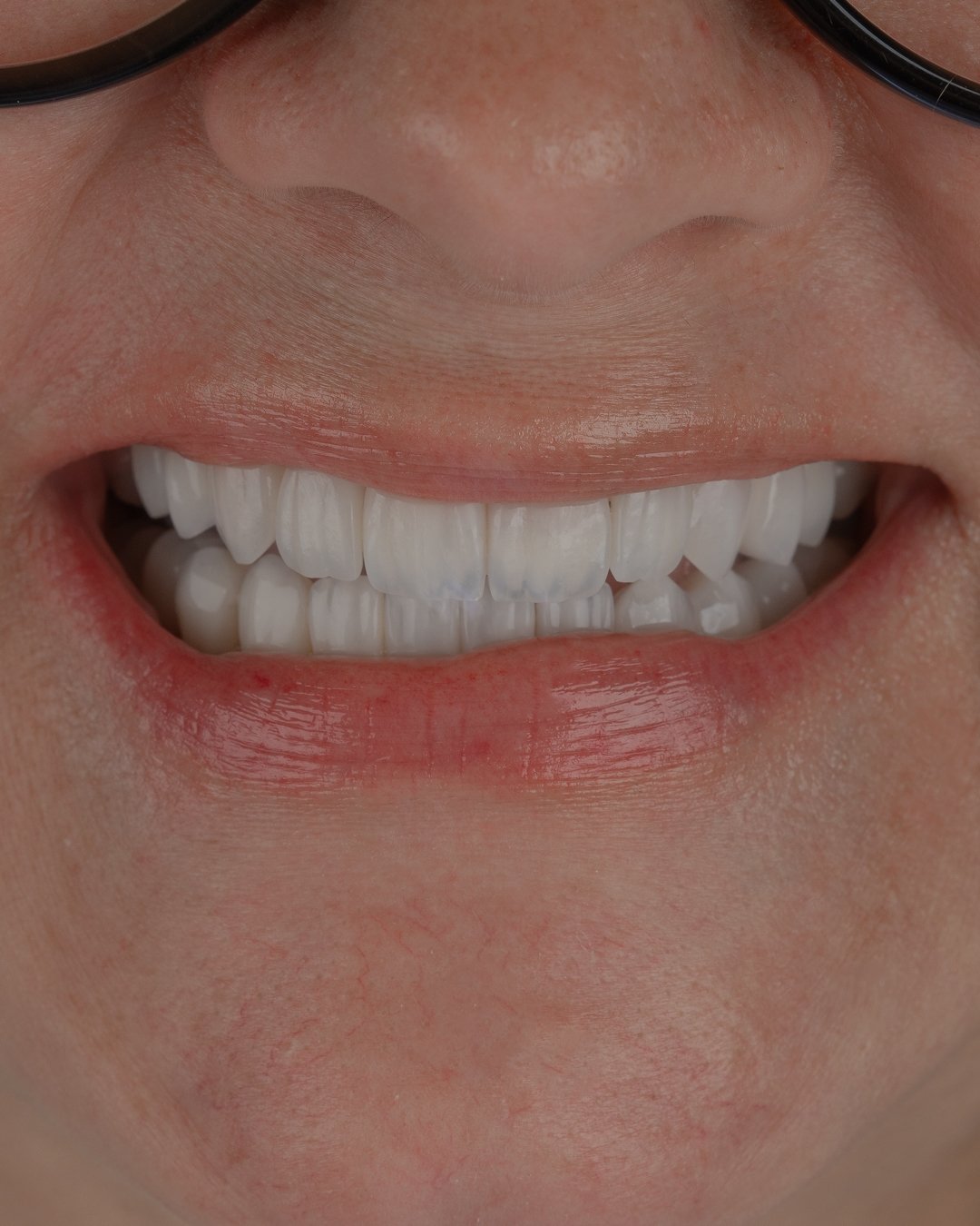 Resultado final de diseño de sonrisa frontal con disilicato de litio estratificado a mano. Dra. Lina Bedoya.
