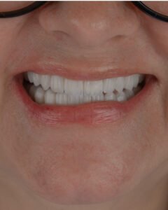 Resultado final de diseño de sonrisa frontal con disilicato de litio estratificado a mano. Dra. Lina Bedoya.