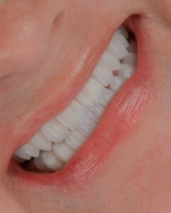 Detalle de carillas de porcelana en disilicato de litio estratificado a mano. Resultado final de alta estética dental por la Dra. Lina Bedoya.