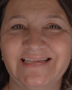 Vista frontal inicial. Desgaste dental severo y pérdida de la dimensión vertical antes del diseño de sonrisa. Dra. Lina Bedoya.