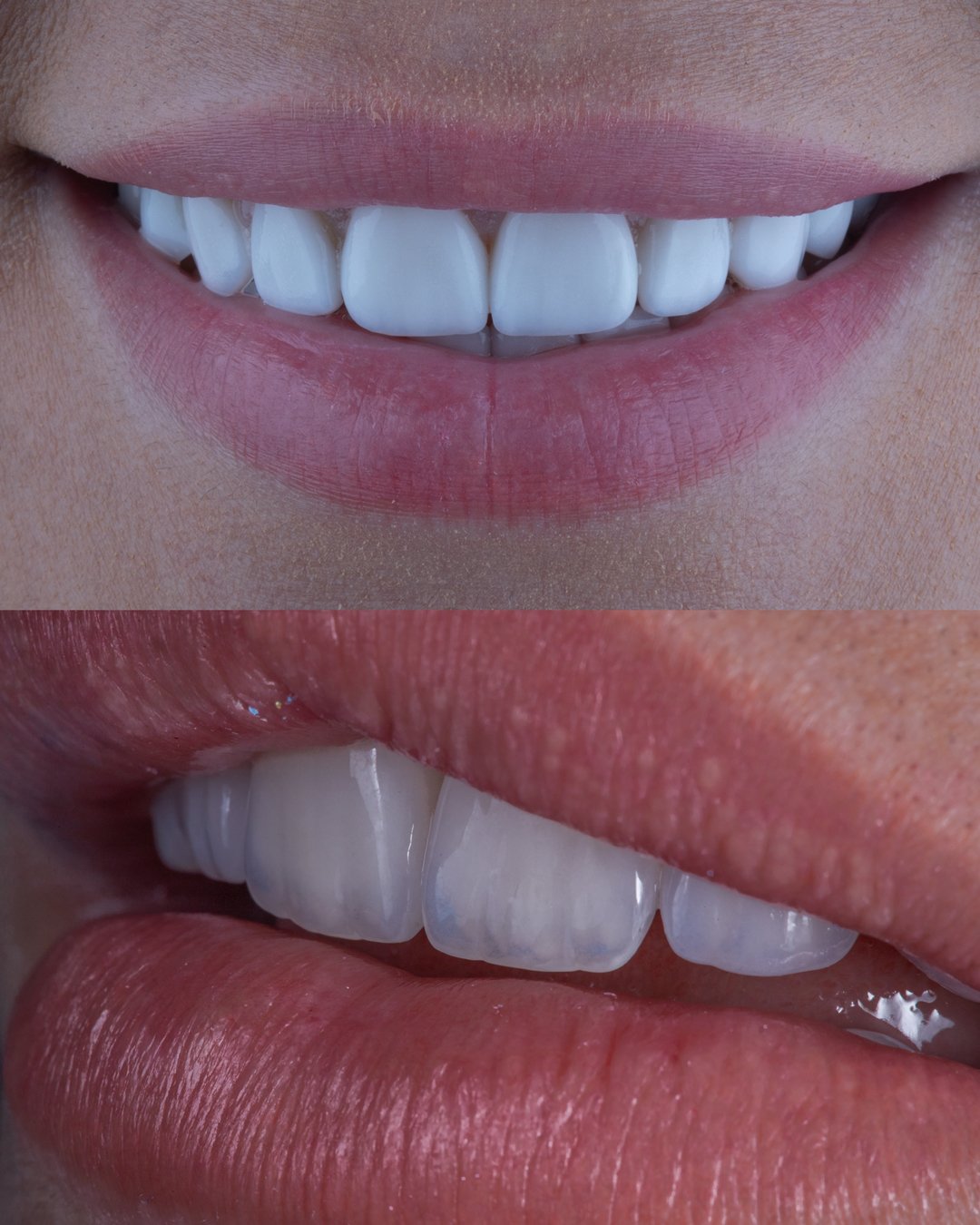 Comparativa de evolución dental: En la parte superior se observa un diseño previo con carillas de aspecto artificial y plano. En la parte inferior se muestra el resultado final realizado por la Dra. Lina Bedoya, destacando una alta naturalidad, bordes incisales con translucidez real y anatomía dental armonizada con el rostro.