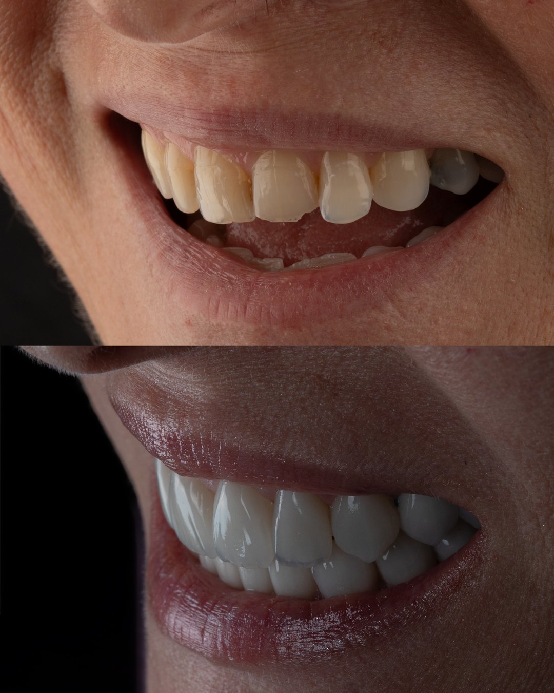 Análisis comparativo de rehabilitación oral estética: La sección superior evidencia una sonrisa con asimetrías en el plano incisal, bordes desgastados y saturación cromática irregular. La sección inferior exhibe el resultado final mediante carillas de disilicato de litio estratificadas a mano, logrando una arquitectura gingival armonizada, macro y microtextura natural, y una reflectividad lumínica similar al esmalte dental natural